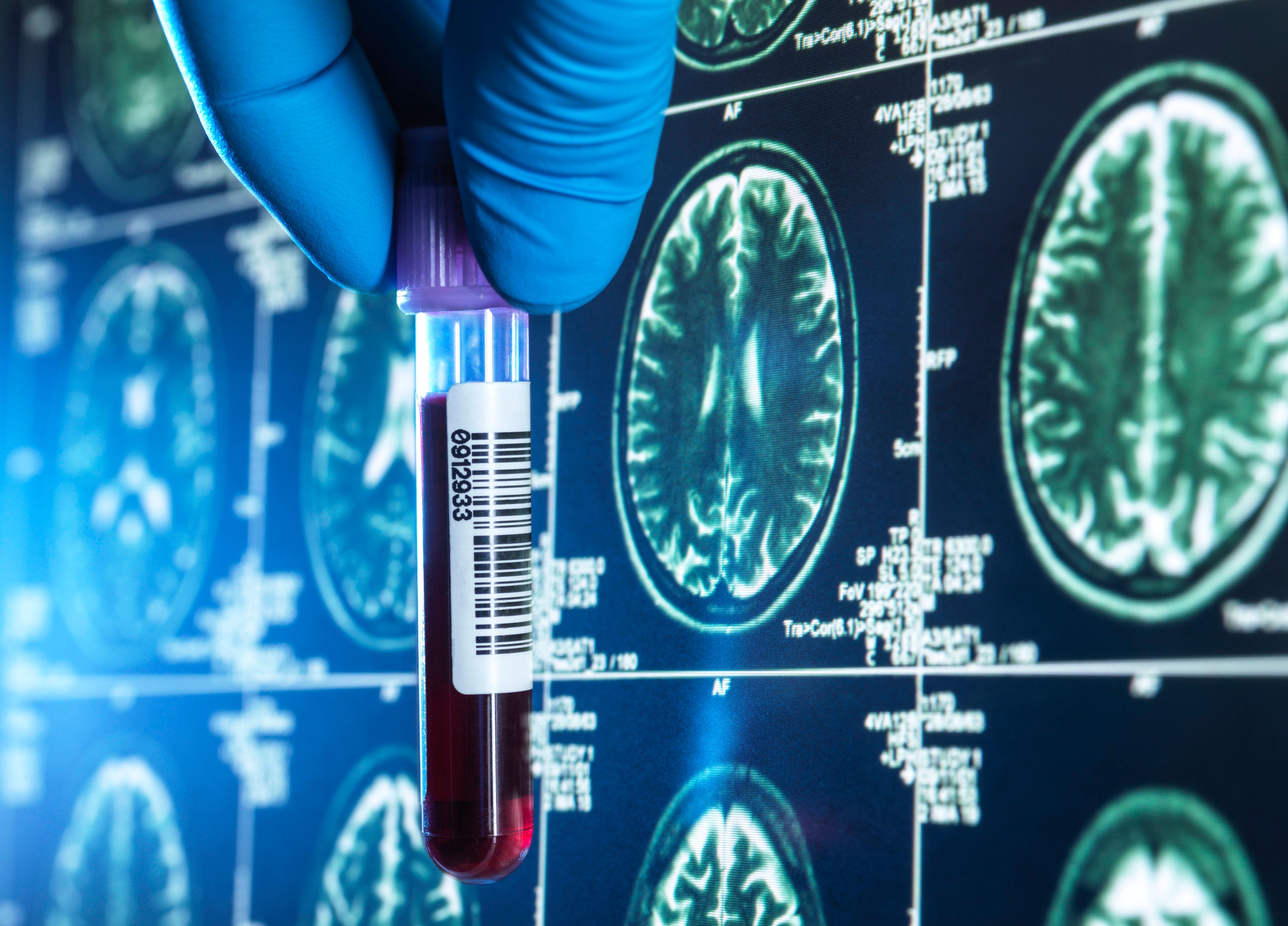 Eigentlich müssten sie erkranken, sie tun es aber nicht: Die Körper von Alzheimerimmunen kennen das Rezept, mit dem sich der Ausbruch einer Demenz verzögern lässt. Wissenschafter wollen den Mechanismus entschlüsseln und auf andere Menschen übertragen.
